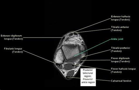 In addition, an image of all the muscles of the back and. MRI ankle - Google Search | Radiology | Pinterest | Search