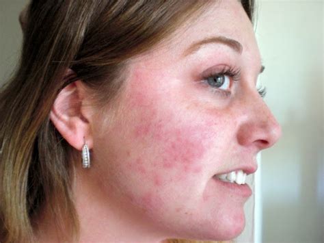 Rash On Face You Should Know Healthy Web M D