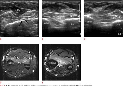 Figure 2 From Ultrasonography For Nerve Compression Syndromes Of The