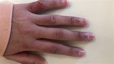 She Couldve Lost Her Fingers Extreme Frostbite Case Prompts Warning From Alberta Mom Ctv News