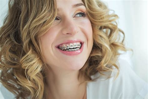 Braces Colors Whats Available And How To Choose Reca Blog