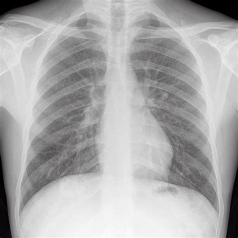 However some patients, who have an acute cardiac infarction, may still have a normal heart size, while other patients who have a large heart due to a chronic heart disease, may. Normal Lung X Ray Stock Photos, Pictures & Royalty-Free ...