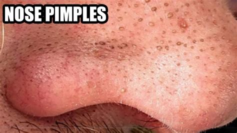 Blackheads On The Nose Blackhead Mask Pimple Popping Week In Review
