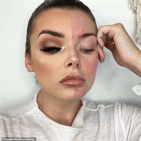 beautician battling severe rosacea reveals the products that banished her redness for good