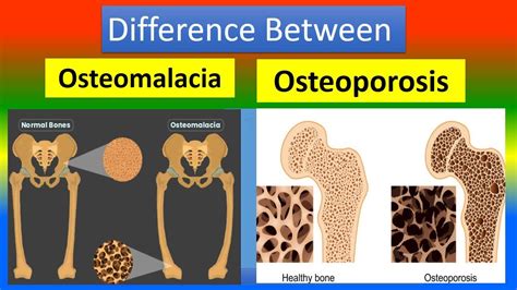 Osteomalacia Bone