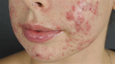 Acne And Congestion Treatment The Face Bar Laser Clinic Darlinghurst Sydney