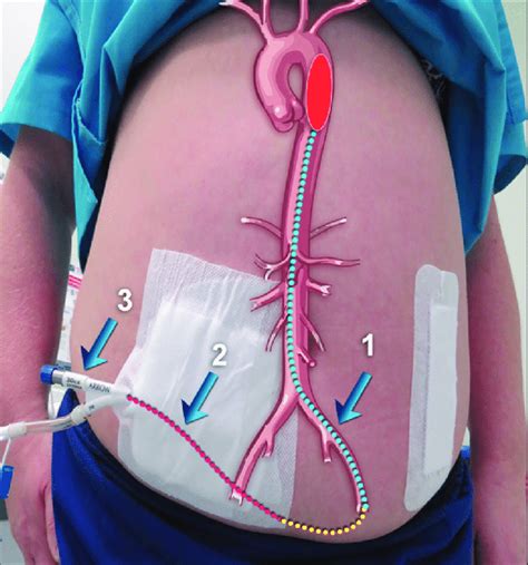 Intra Aortic Balloon Pump Iabp Catheter Insertion Using A Novel Left
