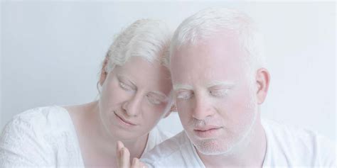 Albinism Heterogeneous Genetic Disorder Newz