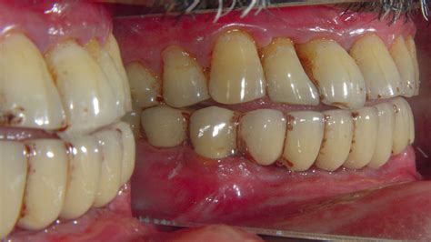 Treated Cases Bridgs And Crowns Restore Dental Treatment Centre