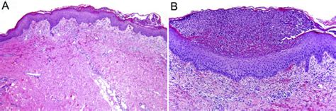 Histologic Appearance Of Pustular Psoriasis A Focal Parakeratosis