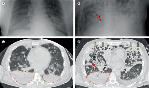Invasive Pulmonary Aspergillosis After Near Drowning The Lancet