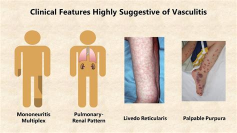 Vasculitis An Overview Youtube