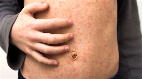 Cdc Warns Measles Could Become Global Threat After Missed Vaccinations