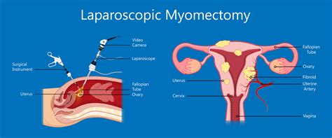 myomectomy surgery melbourne fibroids removal — a prof alex ades
