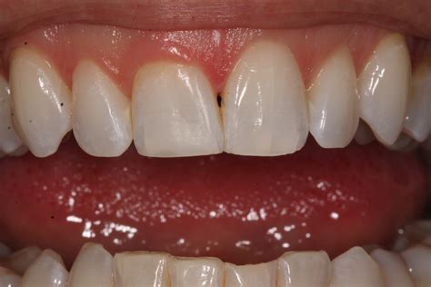 White Tooth Fillings Dental And Composite Bonding Treatments London