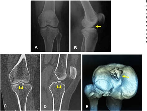 Arthroscopic Reduction Of Adult Comminuted Tibial Eminence Avulsion