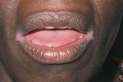 White Spots On Lips Corner Of Mouth