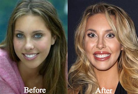 chloe lattanzi before and after plastic surgery photos