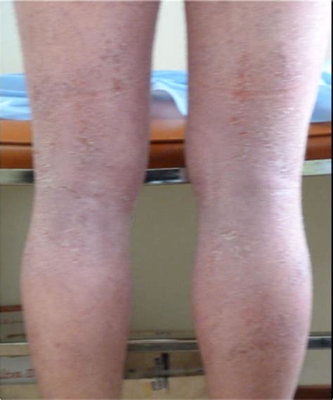 Flexural And Lower Limb Eczema With Erythema And Desquamation In A