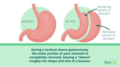 Gastric Sleeve Before And After Stomach How To Know When You Need A