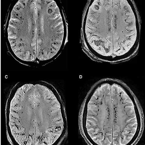 Pdf Diffuse Cerebral Microbleeds After Extracorporeal Membrane