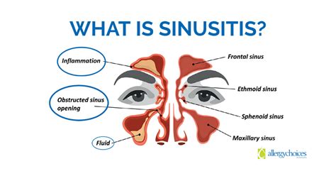 Sinusitis Sinus Infection Symptoms And Treatment