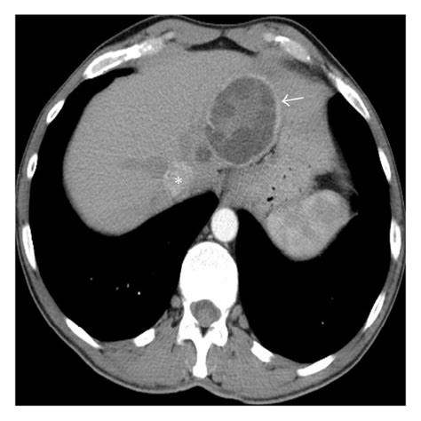 Contrast Enhanced Ct Scan Reveals Typically Hydatid Liver Cyst As Ce 3a