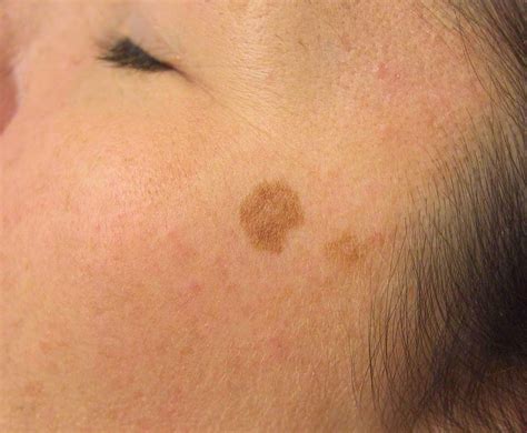 Spots On Skin