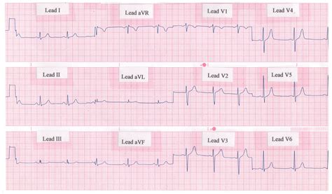 Electrocardiogram (ECG, EKG) Definition, Readings & Procedure