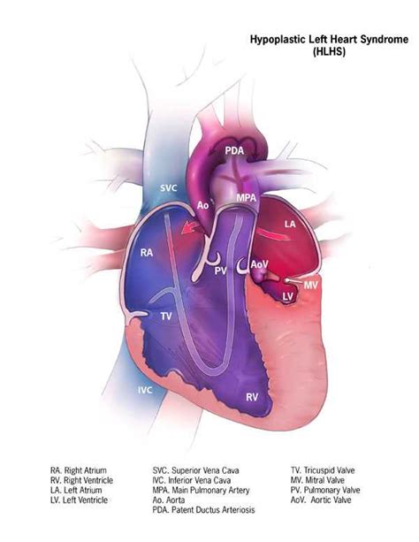 Facts About Hypoplastic Left Heart Syndrome Congenital Heart Defects