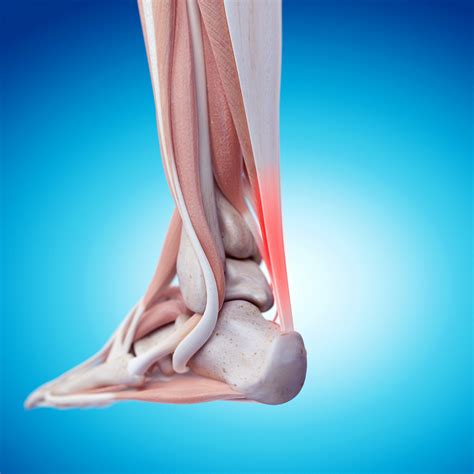 Steroid Injection For Chronic Achilles Tendinopathy Rheumnow