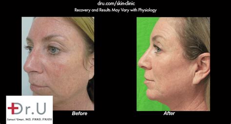 It is a medical procedure that requires training to perform and carries potential risks. Video: Spectra Laser Treatment in Manhattan Beach Los ...