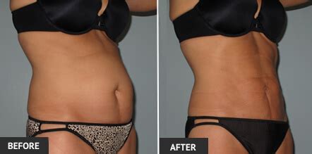 St Louis Laser Liposuction Laser Assisted And Smart Lipo In St Louis MO