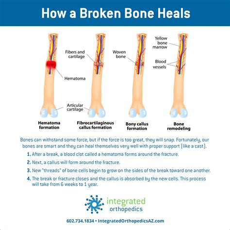How A Broken Bone Heals Broken Ankle Recovery Broken Bone Bone Healing