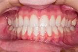 At Home Gum Disease Treatment