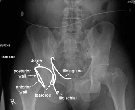 Imaging After Trauma To The Pelvis And Hip The Bmj