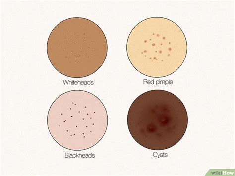 What Do Clogged Pores Look Like 6 Ways To Treat Them