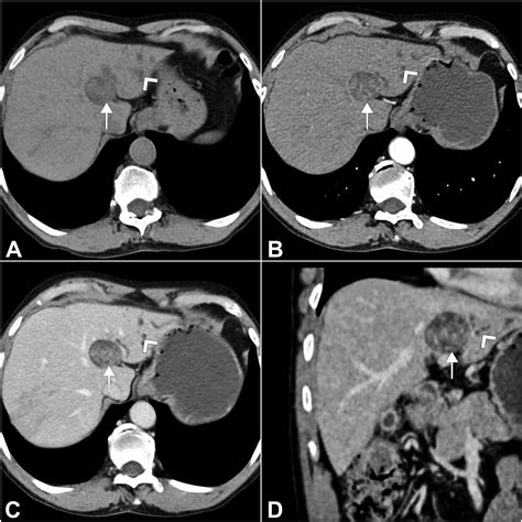 Cureus Intraductal Papillary Neoplasm Of The Bile Duct A Rare Case