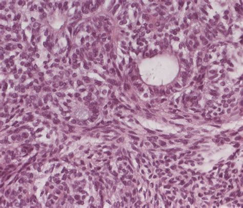 Adenomatoid Odontogenic Tumour Of The Mandible Anticancer Research