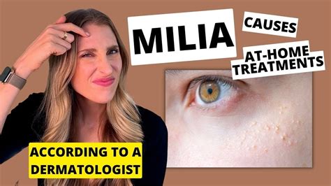 Dermatologist Explains Milia Causes At Home Skincare Treatments