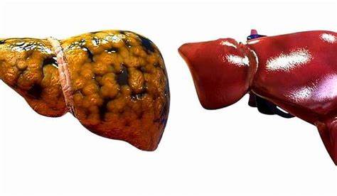 Жировой гепатоз симптомы лечение диета жировой гепатоз печени: симптомы и лечение, препараты | dlja-pohudenija.ru жировой гепатоз печени: симптомы и лечение, препараты | dlja-pohudenija.ru Жировой гепатоз симптомы лечение диета