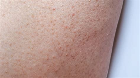 What Is Keratosis Pilaris And Can You Get Rid Of It