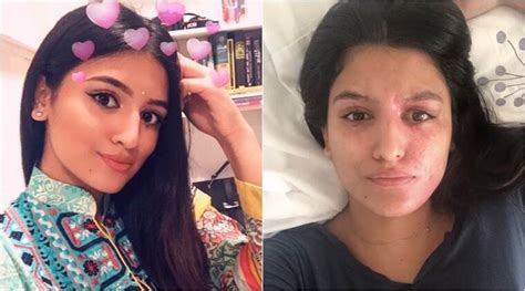 The Acid Attack Survivor Who Shared Her Post Recovery Photos Gets Painfully Honest In Her Latest