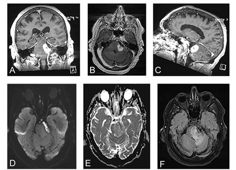 Figure 1 From Intracranial Squamous Cell Carcinoma Arising From A