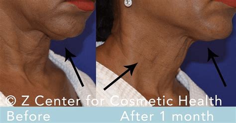 Try These Treatments For Neck Bands Z Cosmetic Health Blog