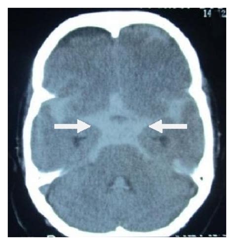 First Ct Scan Brain Without Contrast Showing Suspicion Of Subarachnoid