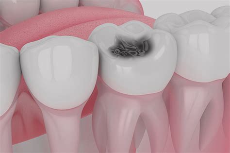 Hole In Tooth Treatment Brooklyn Ny Teeth Cavity Treatments