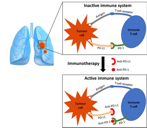 Innovative Research Into The Immunotherapy Success Rate For Lung Cancer
