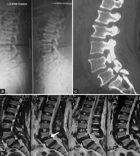 A Flexion And Extension X Rays Of Lumbar Spine Showing Pars