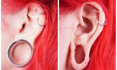 Big Increase In Surgery To Mend Flesh Tunnel Earlobes